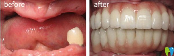 泰州北極星口腔怎么樣？看全口種植牙案例