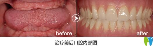 格倫菲爾口腔怎么樣？老年人全口牙缺失種植<span style=