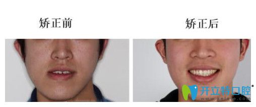 南昌安植雅口腔倪學(xué)敏地包天正頜案例