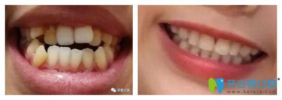美奧口腔隱形牙齒矯正前后對比圖