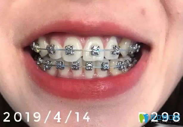 在西安壹加壹戴牙套12個月的照片 在西安壹加壹戴牙套12個月的照片