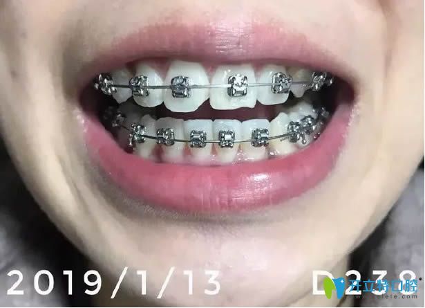 戴自鎖托槽牙套9個月牙齒已經(jīng)排齊了 戴自鎖托槽牙套9個月牙齒已經(jīng)排齊了