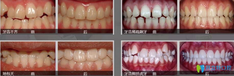 東莞好佰年正畸怎么樣？張子捷幾例子牙齒矯正案例效果對比圖來說明