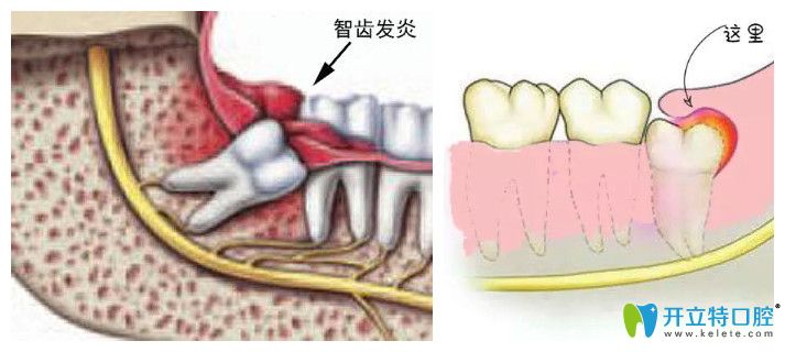 冠周炎圖片