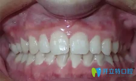 廈門康德佳口腔牙齒矯正術(shù)后照 廈門康德佳口腔牙齒矯正術(shù)后照