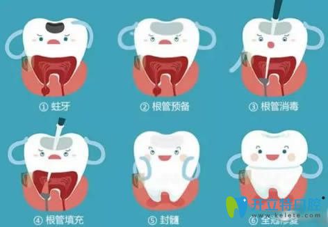 小孩乳牙根管治療步驟圖