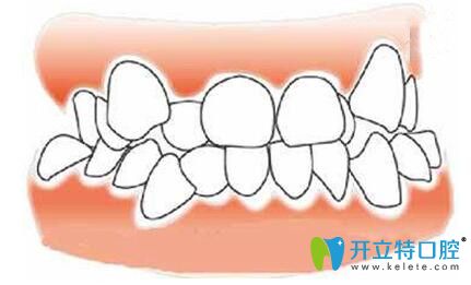 八重牙圖片