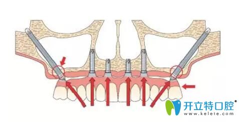 穿顴種植技術(shù)