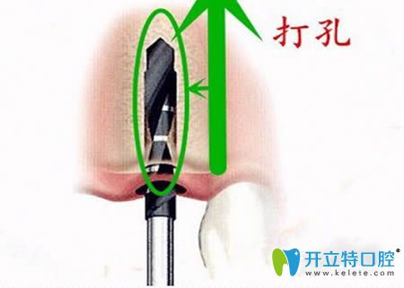 種牙第二步，牙槽骨打孔