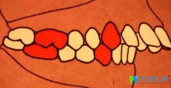 安氏二類錯頜  遠中錯頜  頭一個分類