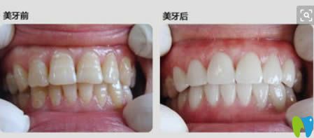 輕度氟斑牙選擇冷光美白后的對(duì)比效果