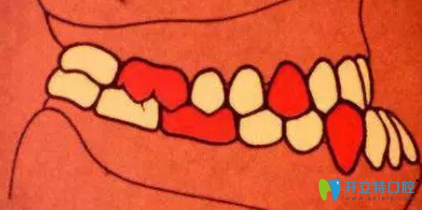 安氏三類錯頜  近中錯頜