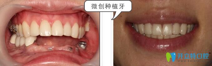 松桃鵬博口腔王鵬院長種植牙案例