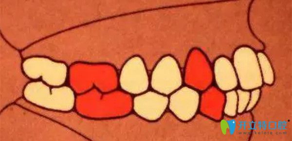 安氏一類錯頜   中性錯頜