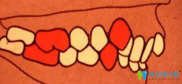 安氏二類錯頜  遠中錯頜  第2分類
