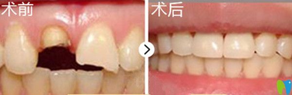牙齒美容修復(fù)前后對比圖