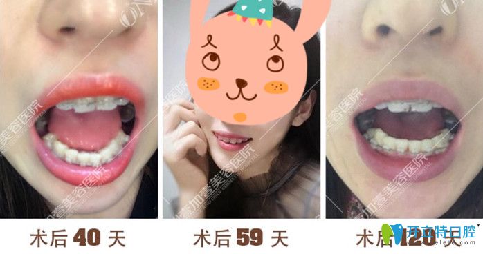 廣州壹加壹矯正40-120天牙齒變化過程圖