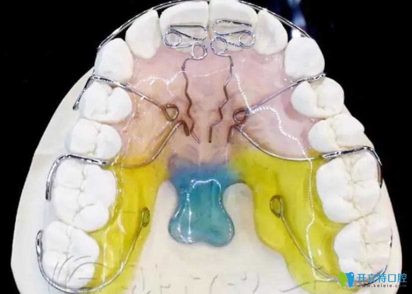 活動(dòng)矯正器多少錢一個(gè)