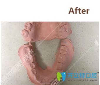 在廣州壹加壹矯正牙齒前取牙模