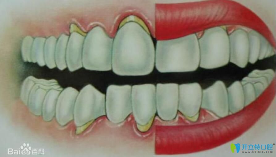 牙槽骨萎縮假牙掛不住，請(qǐng)問(wèn)牙槽骨萎縮還能恢復(fù)嗎？