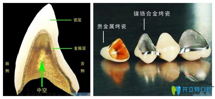 注意,烤瓷牙變成這樣就要及時(shí)拆除啦！