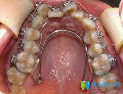 在了解牙弓狹窄怎么矯正前，你還要知道這些……