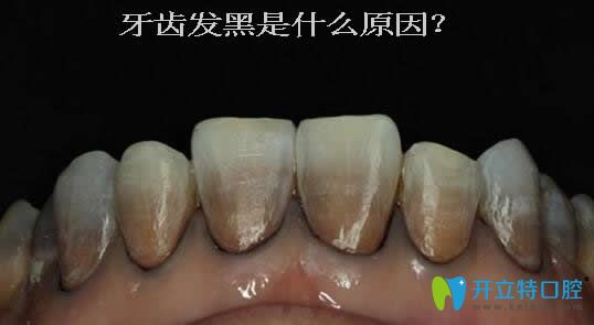 一次性告訴你:牙齒發(fā)黑是什么原因？可能與蛀牙無(wú)關(guān)
