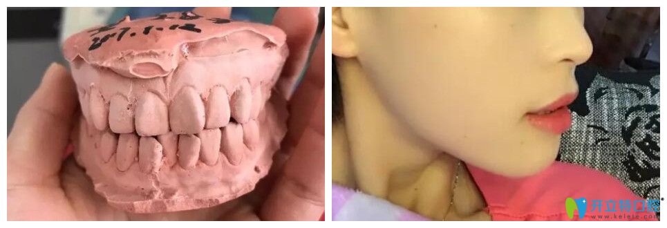 這不僅有上牙外翻圖片，還有上牙外翻矯正的方法及價(jià)格