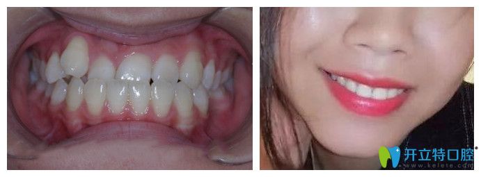 沈陽(yáng)康貝佳口腔隱形牙齒矯正效果