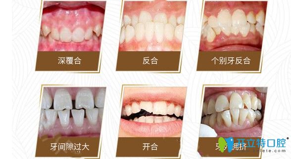 牙齒畸形的情況圖示