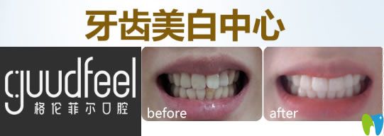 深圳格倫菲爾牙齒美白前后對(duì)比