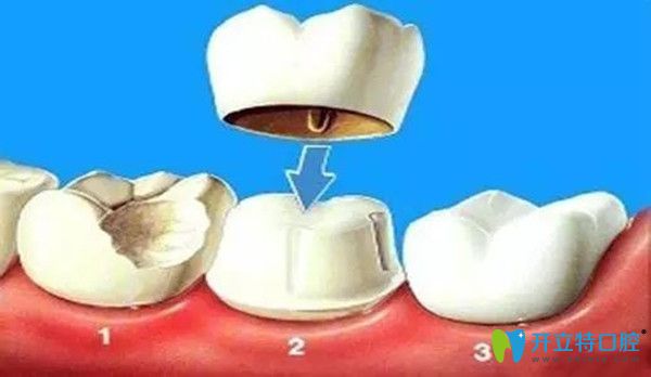 做完牙冠修復(fù)后悔了，牙冠修復(fù)的意義何在？