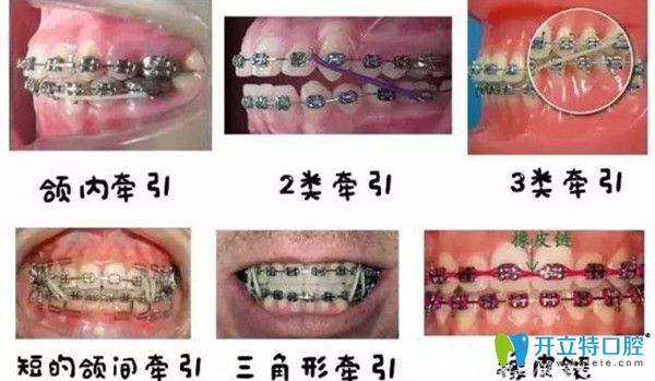 矯正中你所了解的橡皮筋的作用