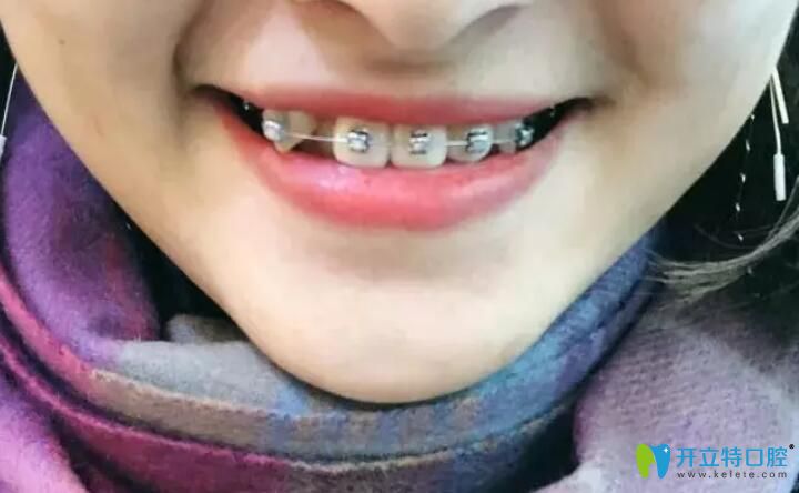 20190507虎牙矯正第42天照片