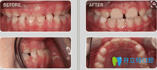 王涪華兒童地包天早期矯正前后對比效果圖