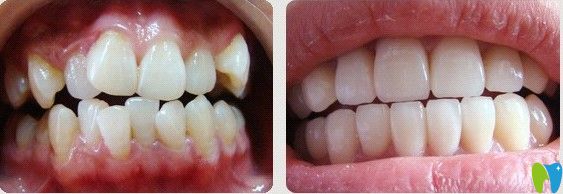 王涪華院長青少年牙齒擁擠矯正前后對比照