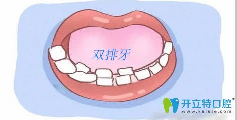 孩子門牙里面又長出小門牙是咋回事?洛陽九龍口腔帶您了解