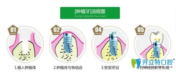 謝精文醫(yī)生科普：種植牙疼不疼