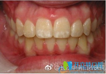 在長(zhǎng)沙中諾口腔做對(duì)刃頜矯正一年多后效果圖