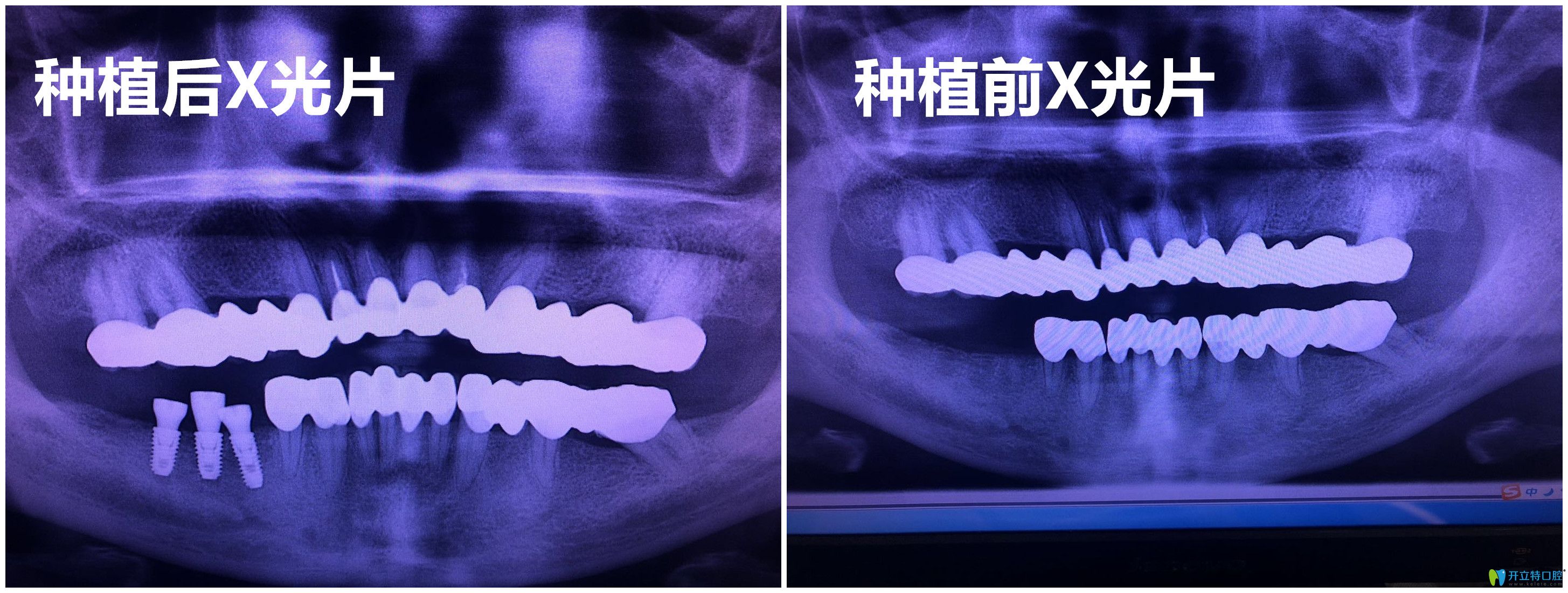 杭州逸盛口腔謝精文種植牙案例