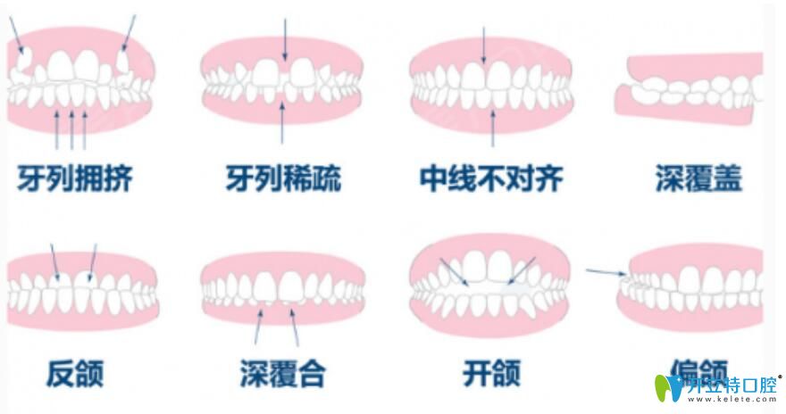 什么是上下牙齒咬合不齊