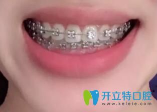 我在合肥崔勁松口腔做金屬托槽牙齒矯正13個(gè)月