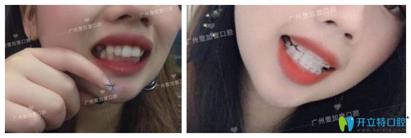 廣州壹加壹齙牙、牙齒擁擠不齊矯正案例效果前后對比照片