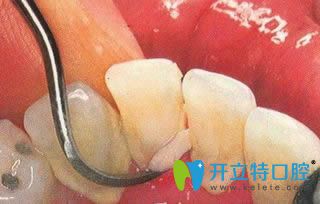 張剛醫(yī)生提倡牙齒疾病要從定期洗牙做起