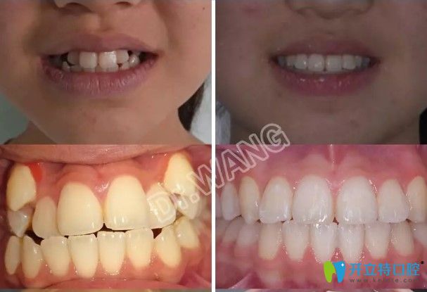 在杭州雅萊做完隱適美對刃頜矯正對比效果及臉型變化圖