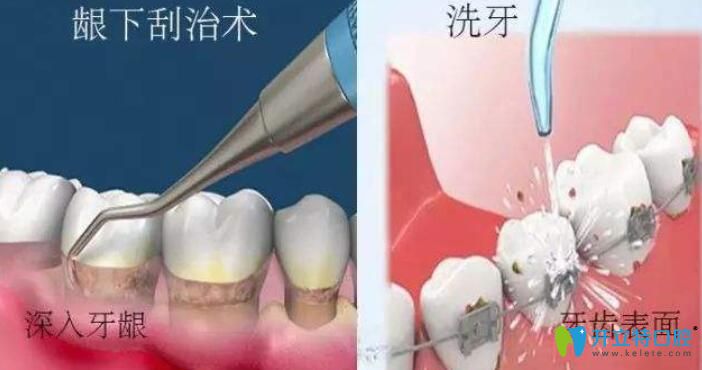 丁曉虹主任講解：牙周治療和洗牙的區(qū)別