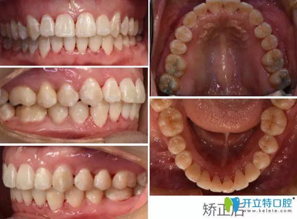 正畸前后對比圖