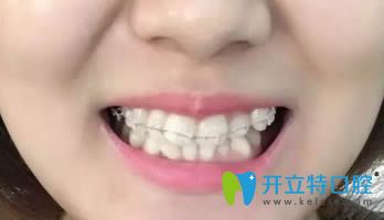 在連江縣明輝口腔做的陶瓷矯正歷經(jīng)18個(gè)月終于要下牙套了！