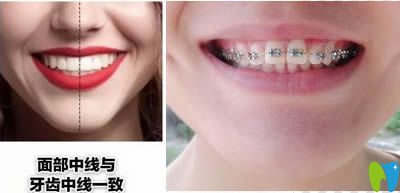 連江縣胡明輝口腔講解牙齒矯正拔牙與不拔牙的區(qū)別
