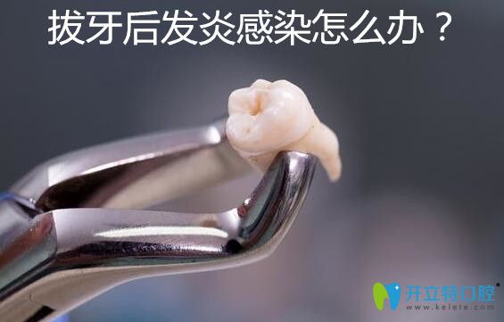 拔牙后發(fā)炎感染了怎么辦？感染癥狀有哪些你知道嗎？